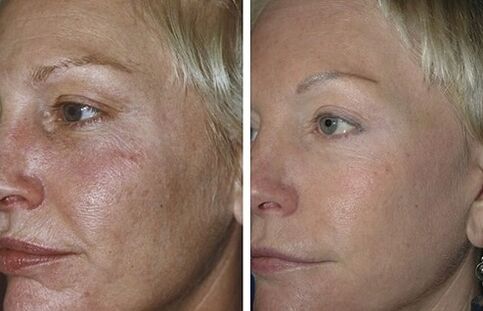 Fractional laser αναζωογόνηση πριν και μετά τις φωτογραφίες