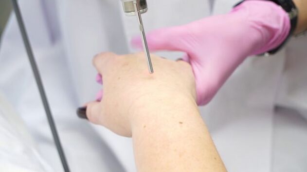 Laser ανανέωση δέρματος χεριών
